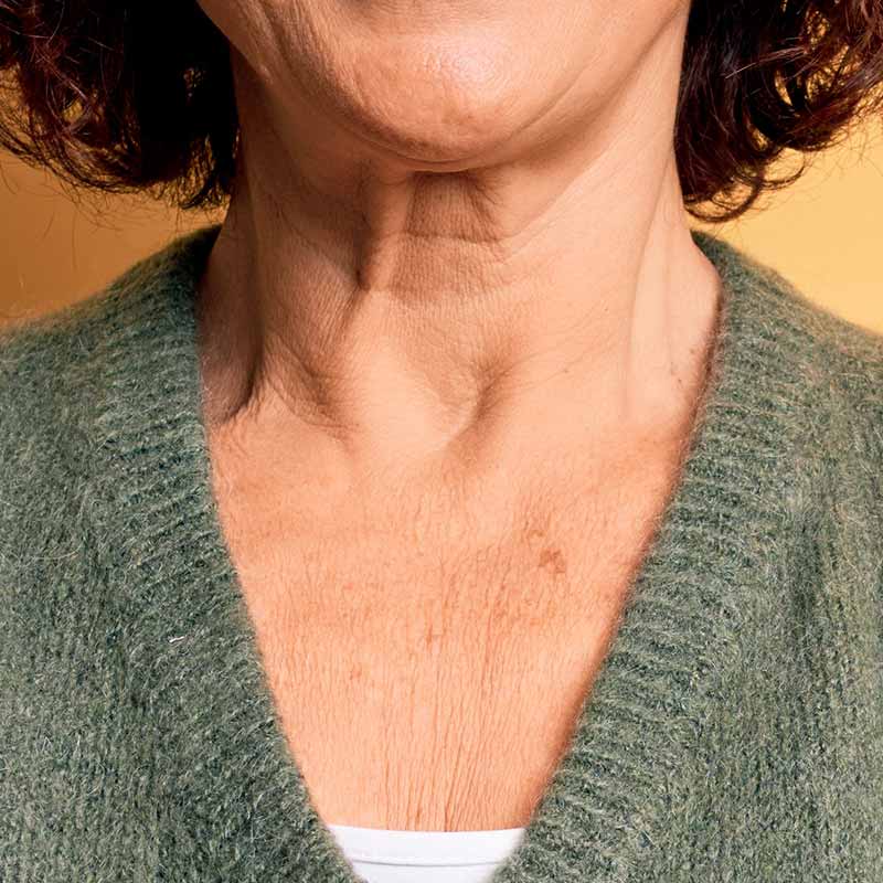 vieillissement du cou et du décolleté