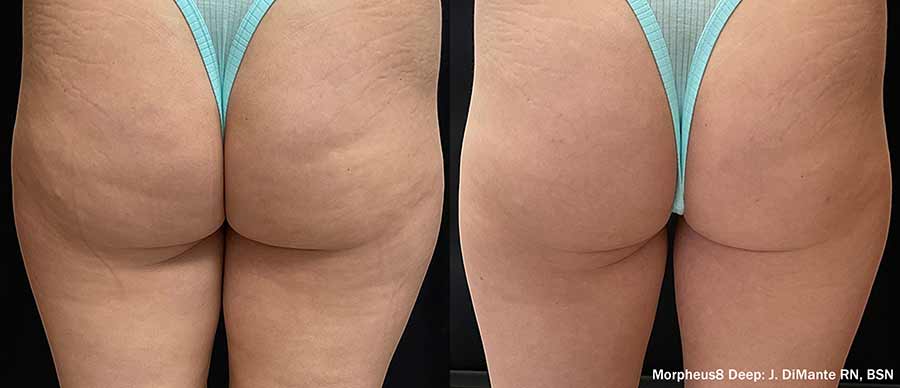 Résultats avant-après