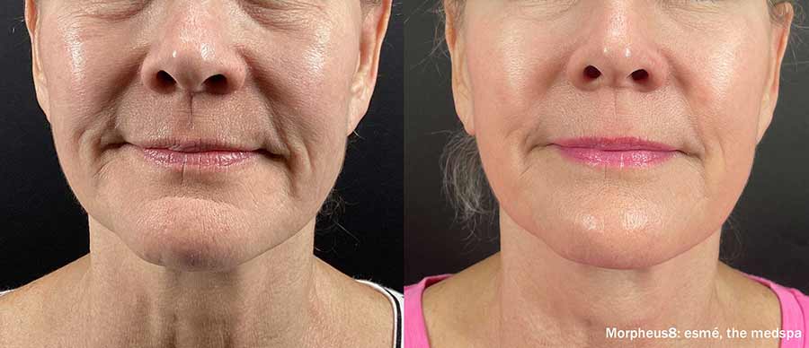 Résultats avant-après