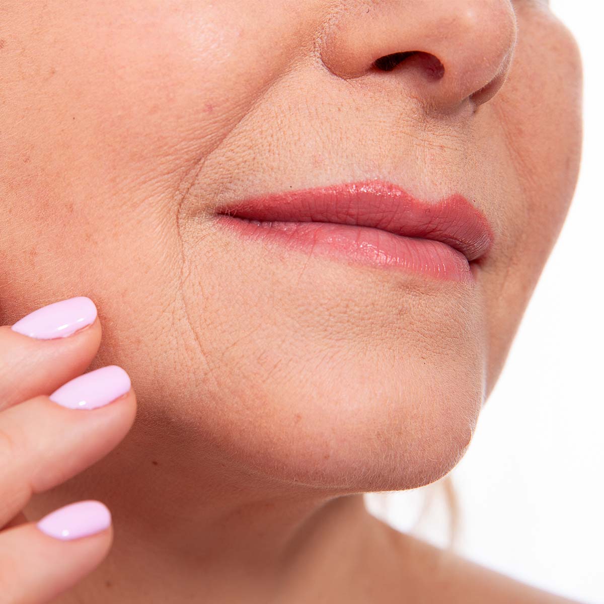 traitement des rides - avant