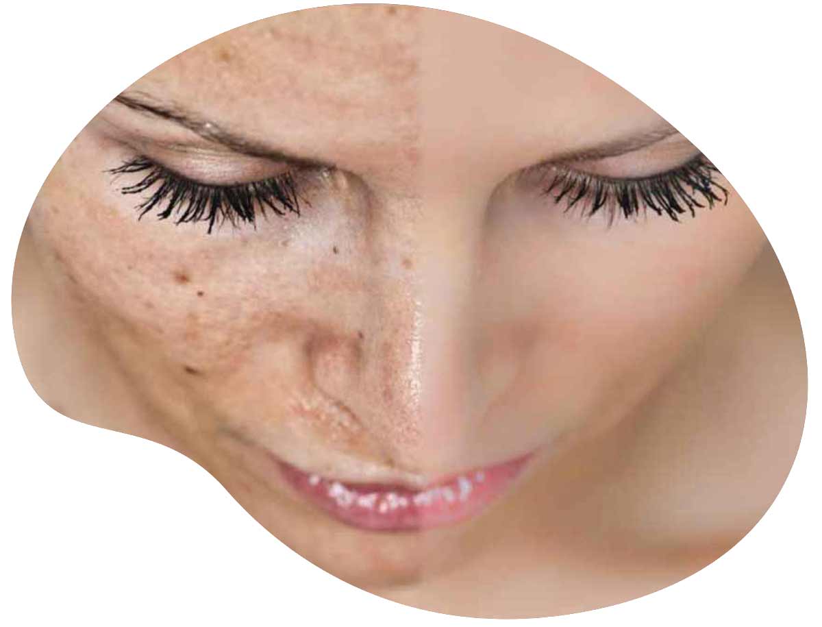 traitement des taches pigmentaires avant-après