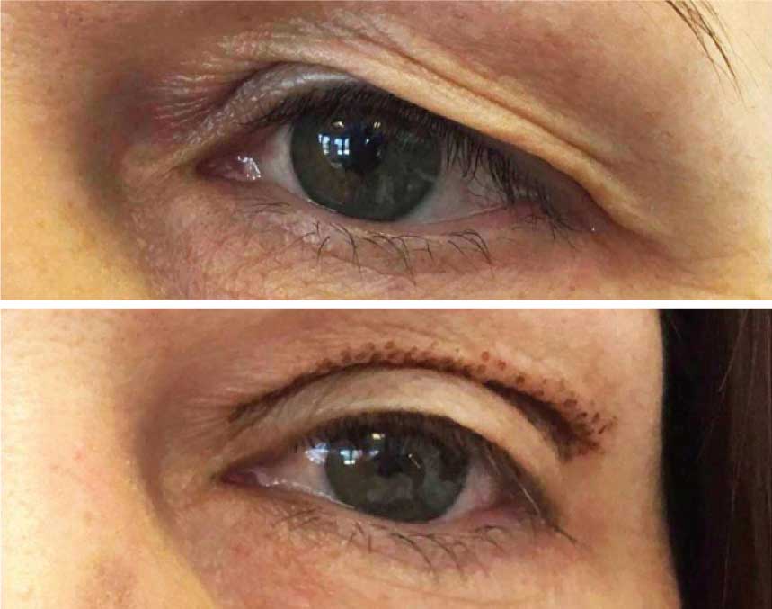 blépharoplastie sans chirurgie avec PlexR Plus Plasma