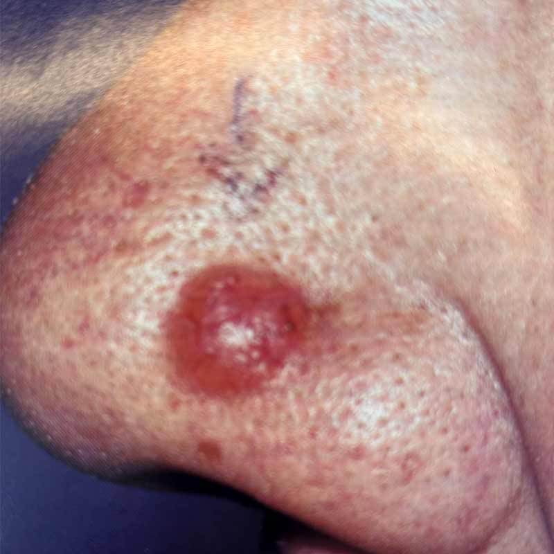 cancer basocellulaire