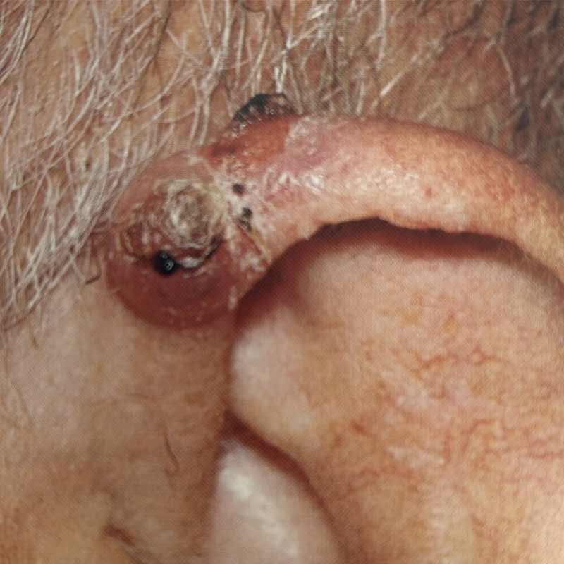 cancer spinocellulaire