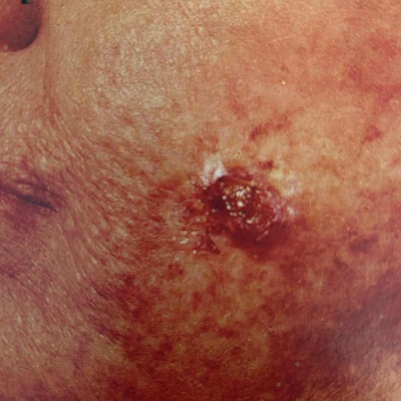 cancer spinocellulaire