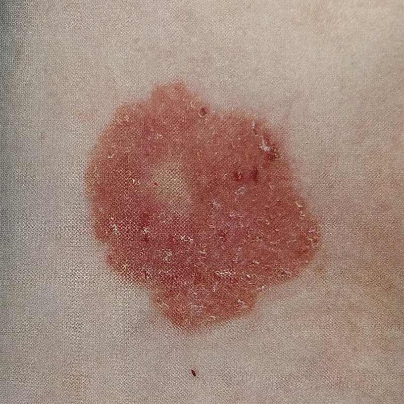 cancer spinocellulaire