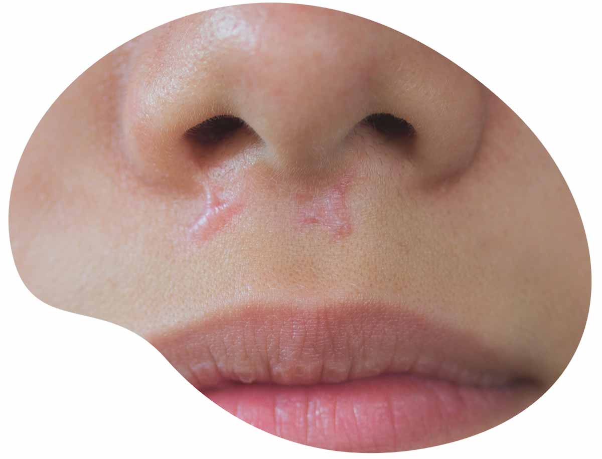 traitement au laser de cicatrices - avant