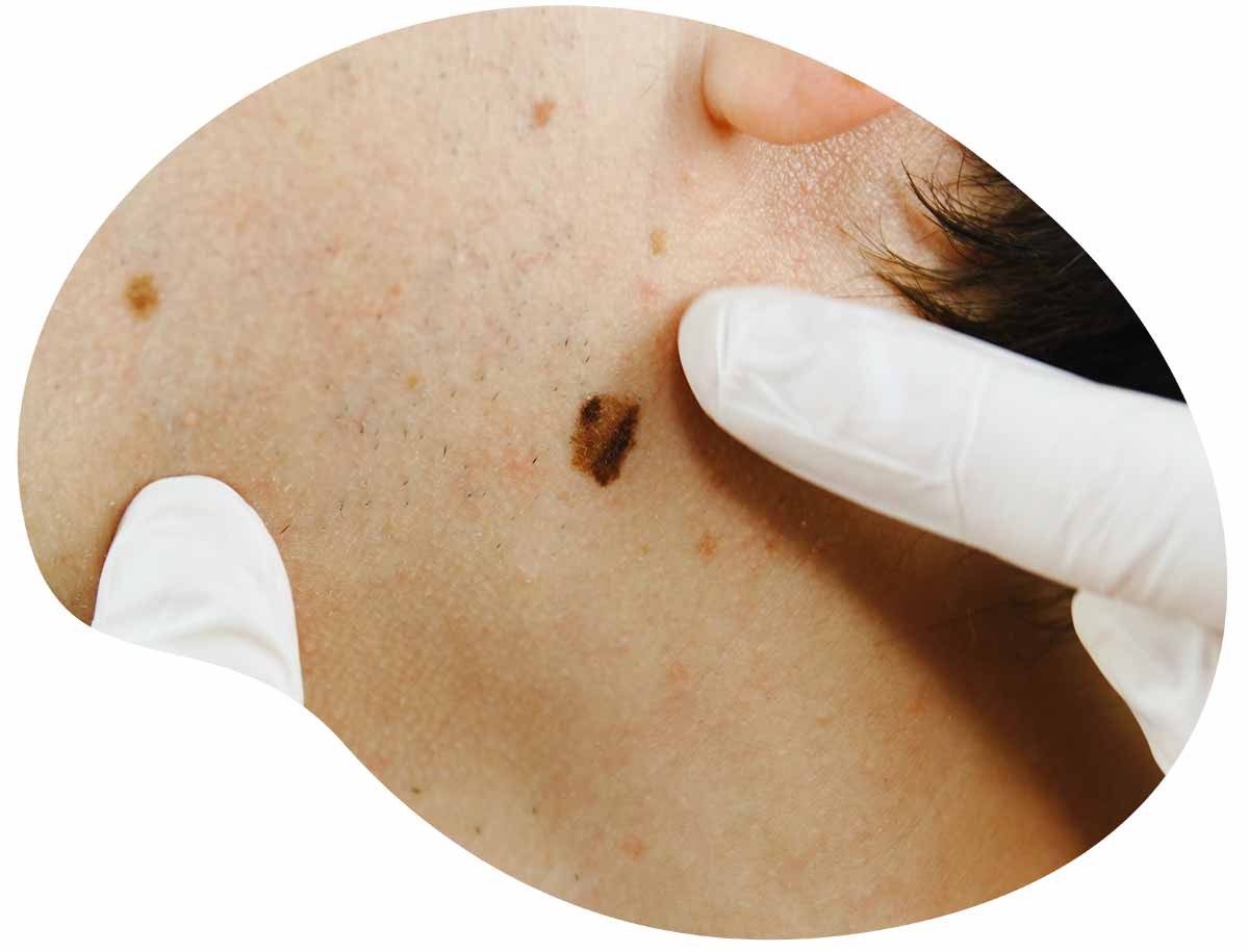 détection de la cancer de la peau