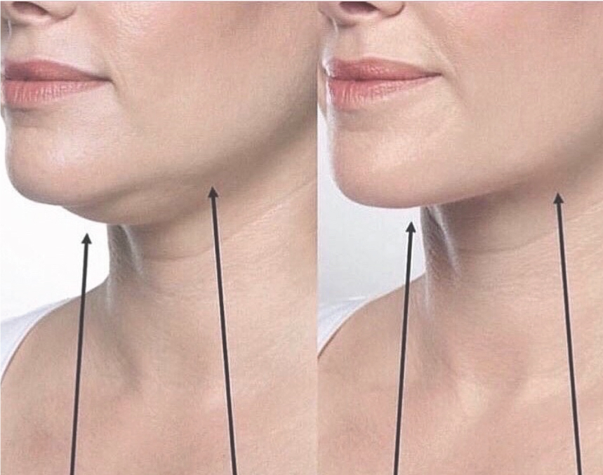 Réduction du double menton sans chirurgie