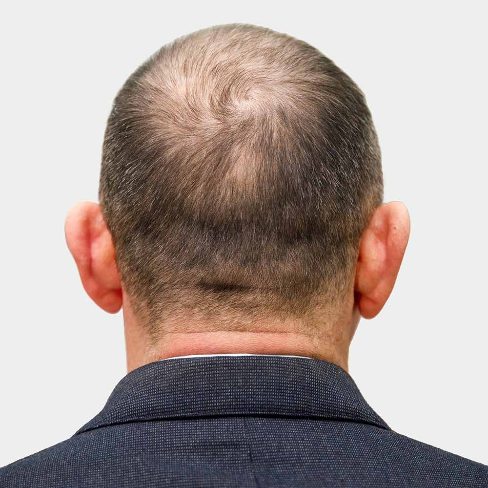 traitement pour la perte des cheveux - avant