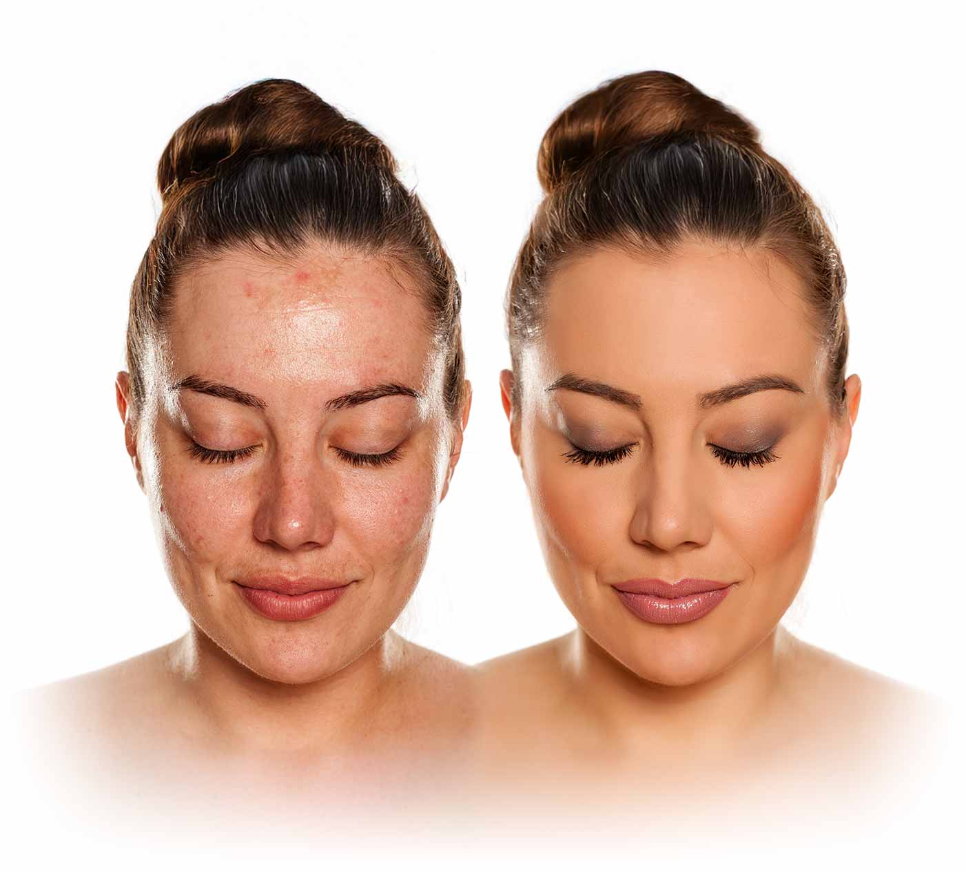 traitement de l’acné avant-après