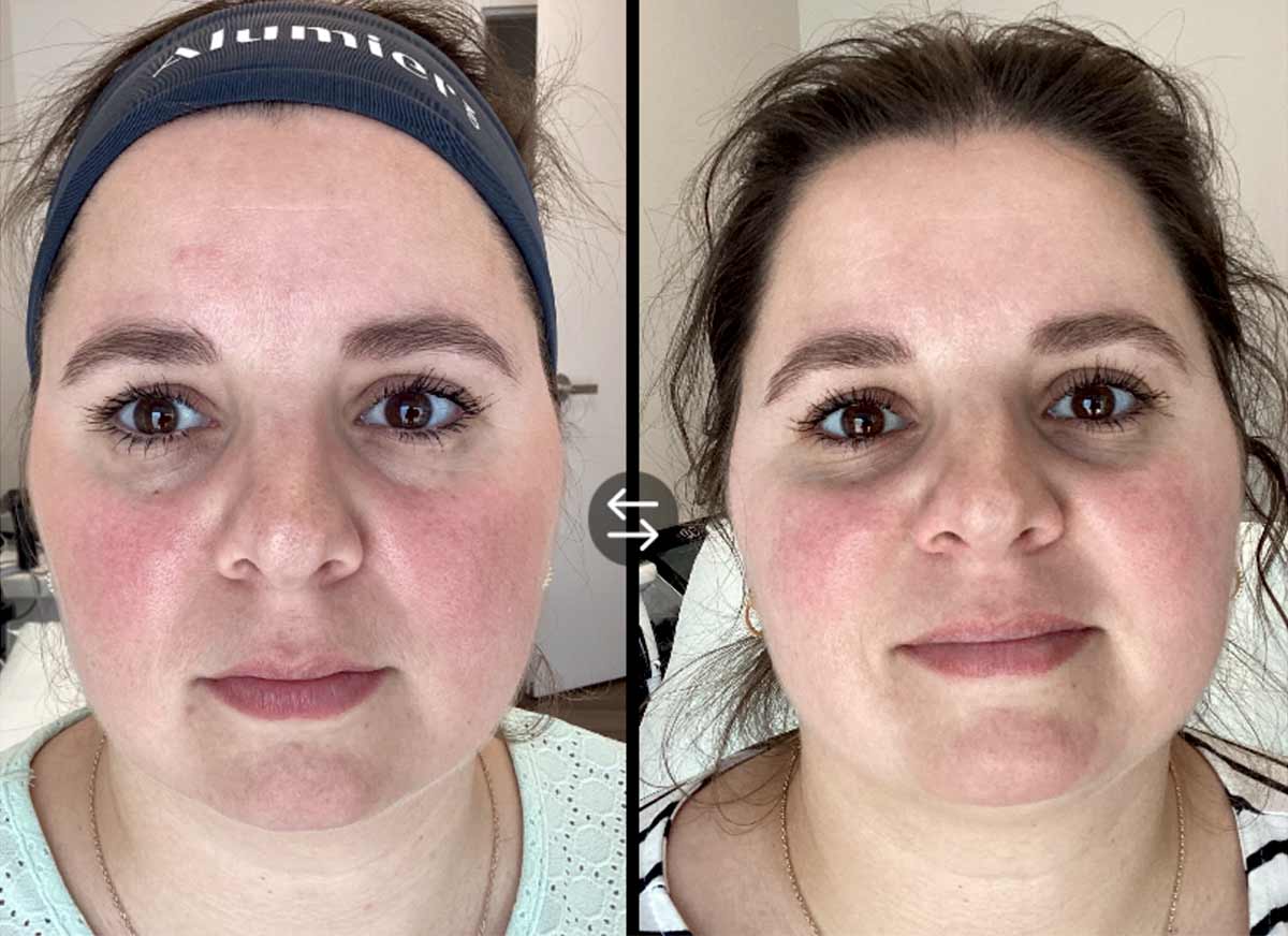 femme avant et après le traitement de la rosacée