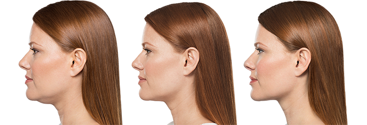 injections de Belkyra - avant-après Adra