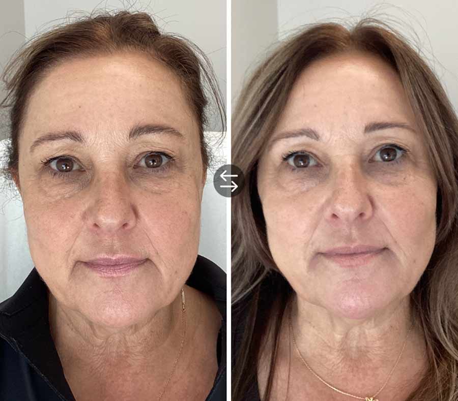 injections d'agent de comblement