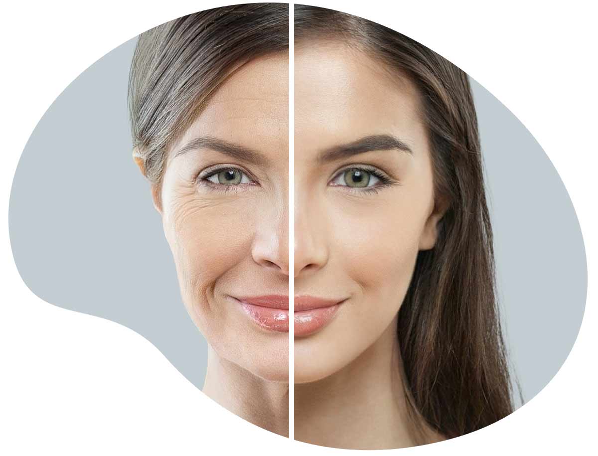 injections d’acides hyaluronique avant-après