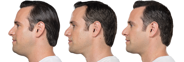 injections de Belkyra - avant-après Jason