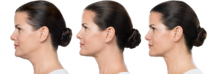 injections de Belkyra - avant-après Jennifer