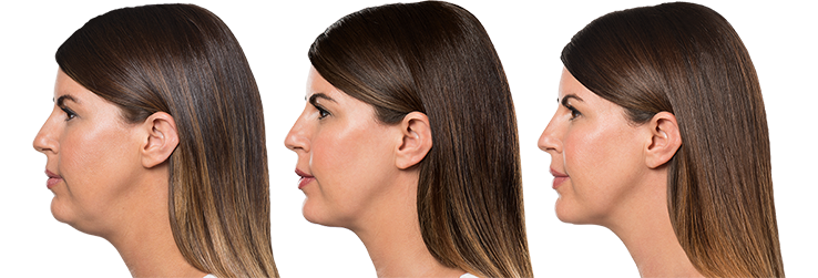 injections de Belkyra - avant-après Nikki