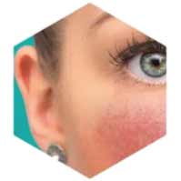 traitement de la rosacée avec IPL