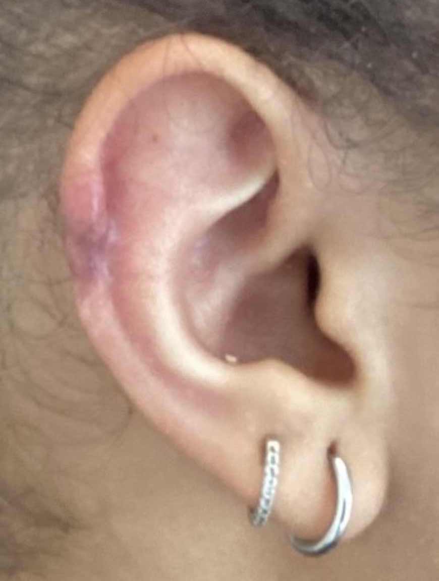 Cicatrice chéloïde après combinaison de traitement