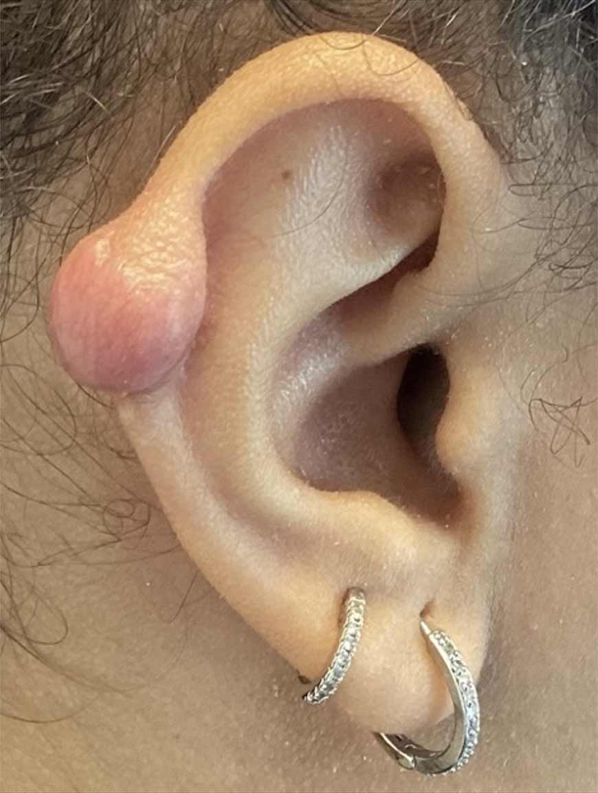 Cicatrice chéloïde avant le traitement