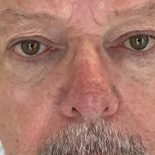 traitement de la téléangietasie avec IPL - après