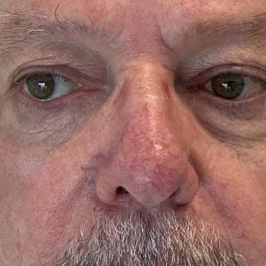 traitement de la téléangiectasie avec IPL - avant