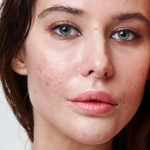 traitement-acne traitement de l'acné