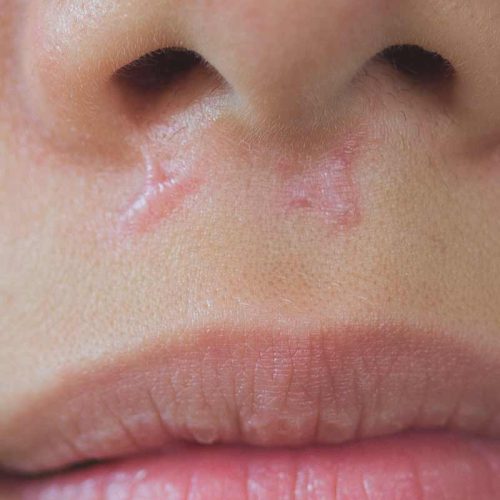 traitement-cicatrice traitement des cicatrices