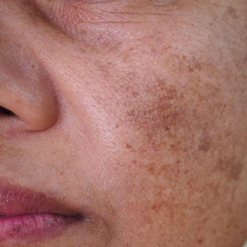 traitement-taches-pigmentaires traitement des taches pigmentaires