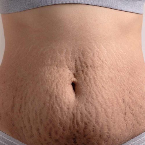 vergetures-ventre vergetures